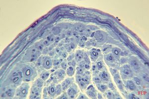n. suralis - hypertrophic demyelinizing neuropathytoluidine-blue-stained semithin section n. suralis - hypertrophic demyelinizing neuropathytoluidine-blue-stained semithin section